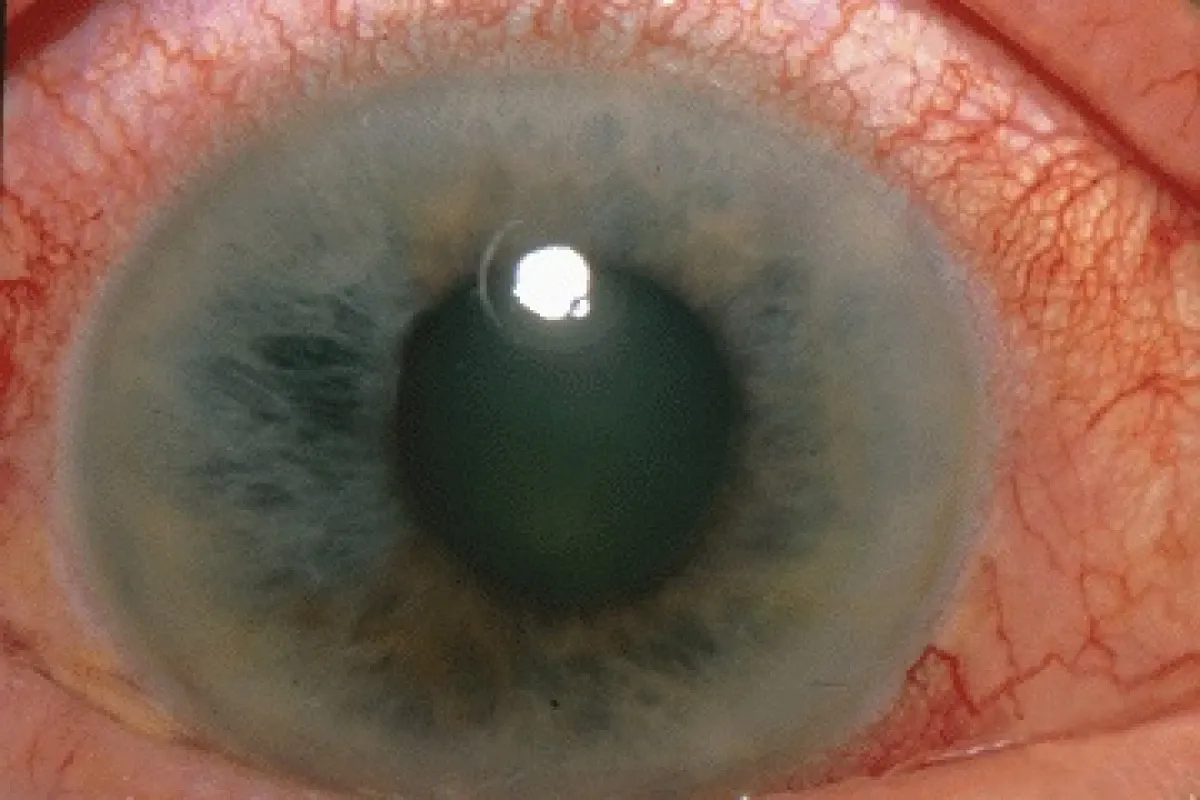 Ophtalmologie Chambéry